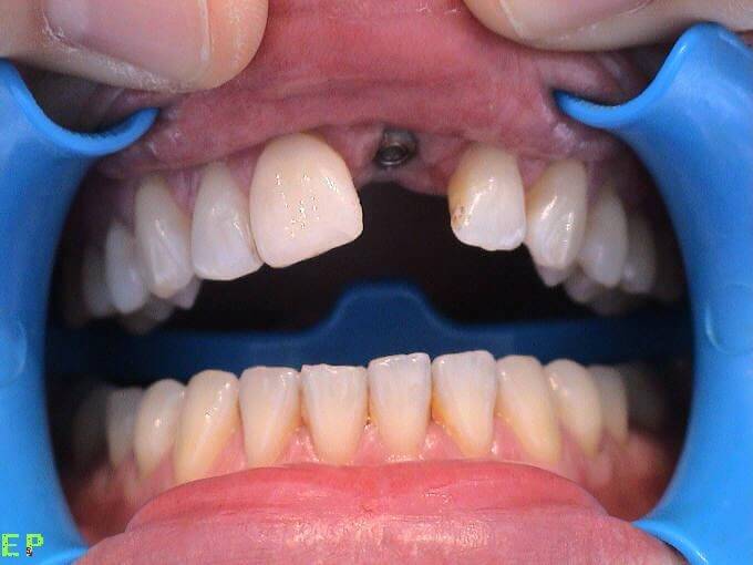 incisor-implant