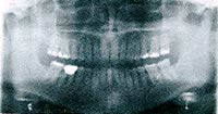 A panoramic x-ray is taken in a special machine of the entire jaws. It shows the entire jaw areas but not in the detail of individual films. Areas that can’t be seen with the routine set of x-rays can be seen such as wisdom teeth, sinuses and the joints.