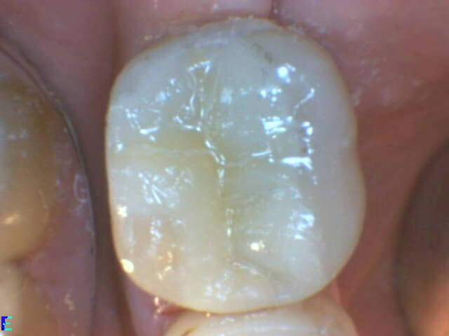 tooth_coloured_inlay1