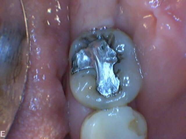 tooth_coloured_inlay_before1