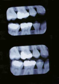 Where appropriate low radiation digital x rays are taken and displayed on the computer screen.These x rays show areas between the teeth and underneath fillings which are not detectable with just visual examination.