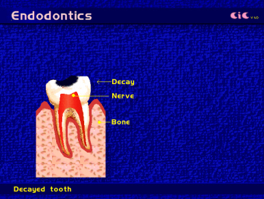 endod2